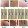 6 pcs Medical Plasters Foot Corn Removal Warts Thorn Patch Curative Patches Calluses Callosity Detox Foot Pads Toe Patches. 