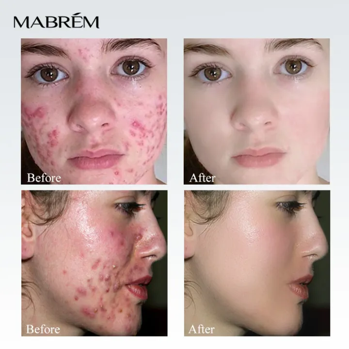 Danshen%20Acne%20Cream%20Acne%20Removal%20Fades%20Acne%20Marks%20Repair%20Damaged%20Skin%20Gentle%20Non-Irritant%20Skin%20Rejuvenating%20Nourishing%20Skin%20Care%20-%20Image%204