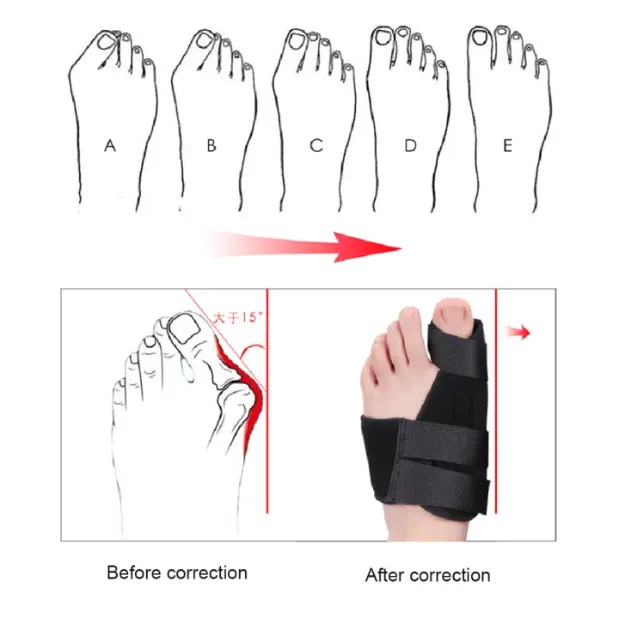 1%20pcs%20Soft%20Bunion%20Corrector%20Toe%20Separator%20Splint%20Correction%20System%20-%20Provide%20Medical%20Device%20Support%20for%20Hallux%20Valgus%20and%20Foot%20Care%20-%20Image%202