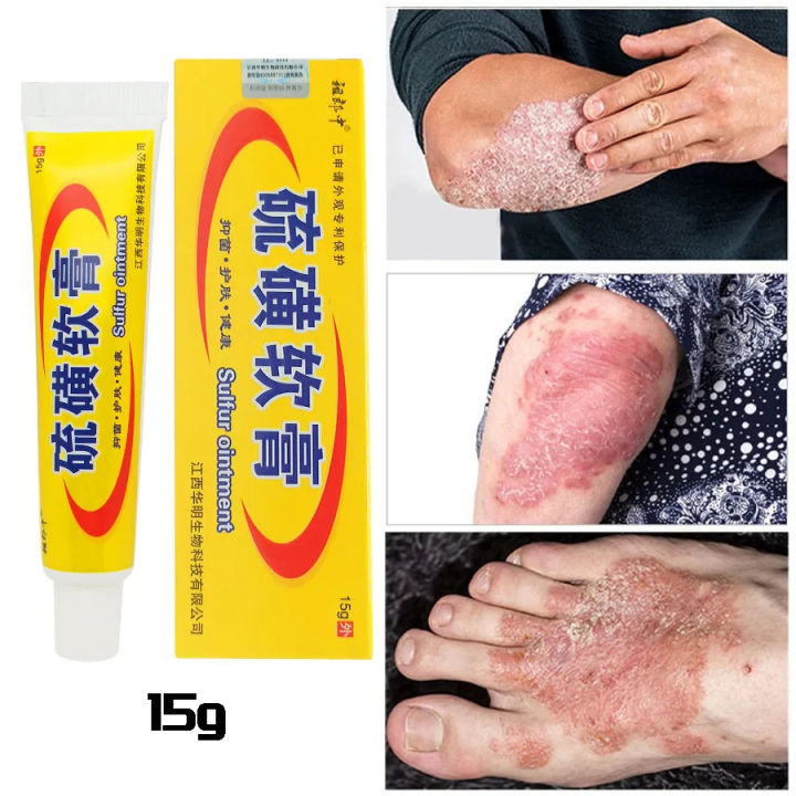 Sulfur%20Antibacterial%20Cream%20Soap%20Spray%20Set%20Psoriasis%20Eczema%20Anti-itch%20Relief%20Rash%20Urticaria%20Desquamation%20Ointment%20Body%20Skin%20Care%20-%20Image%203