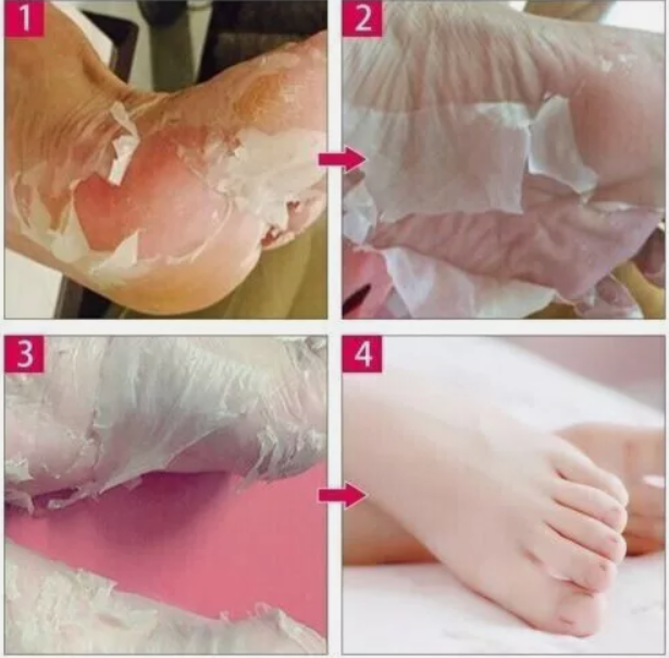 Exfoliating%20Peel%20Off%20Foot%20Mask%20Remove%20Hard%20Dead%20Skin%20Callus%20Sock%20Baby%20Soft%20Feet%20-%20Image%203