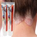 15g Chinese Medicine Psoriasis Ointment Treat Fungal Dermatitis Antipruritic Dressing Skim Eczema Antibacterial Repair Ointment. 