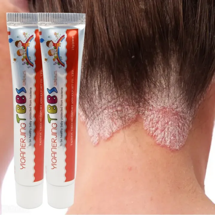 15g%20Chinese%20Medicine%20Psoriasis%20Ointment%20Treat%20Fungal%20Dermatitis%20Antipruritic%20Dressing%20Skim%20Eczema%20Antibacterial%20Repair%20Ointment%20-%20Image%207