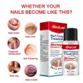 Nail Fungus Treatment 7 Day Repair Potion Essence Anti Infective Onychomycosis Nail Fungus Removal Gel Foot Care. 