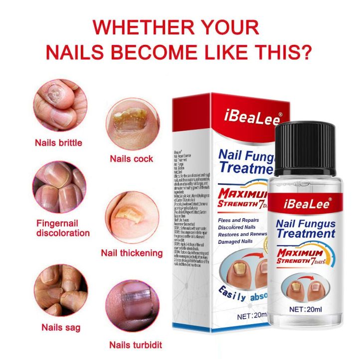 Nail%20Fungus%20Treatment%207%20Day%20Repair%20Potion%20Essence%20Anti%20Infective%20Onychomycosis%20Nail%20Fungus%20Removal%20Gel%20Foot%20Care%20-%20Image%205