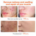 Acne Treatment Cream Anti Acne Face Cream Pimple Removal Spots Oil Control Shrink Pores Moisturizing Skin Care Cream. 