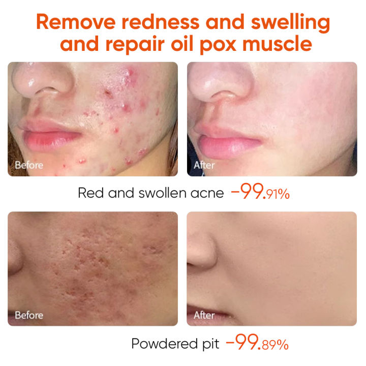 Acne%20Treatment%20Cream%20Anti%20Acne%20Face%20Cream%20Pimple%20Removal%20Spots%20Oil%20Control%20Shrink%20Pores%20Moisturizing%20Skin%20Care%20Cream%20-%20Image%202