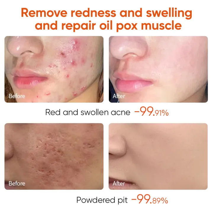 Acne%20Treatment%20Cream%20Anti%20Acne%20Face%20Cream%20Pimple%20Removal%20Spots%20Oil%20Control%20Shrink%20Pores%20Moisturizing%20Skin%20Care%20Cream%20-%20Image%202