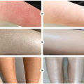 Coarse body hair, removal, cyst removal, Pila, good cream, keratosis, hairy chicken, skin condition, hole modification, dark spots, moisturizing, whitening, smooth skin care. 