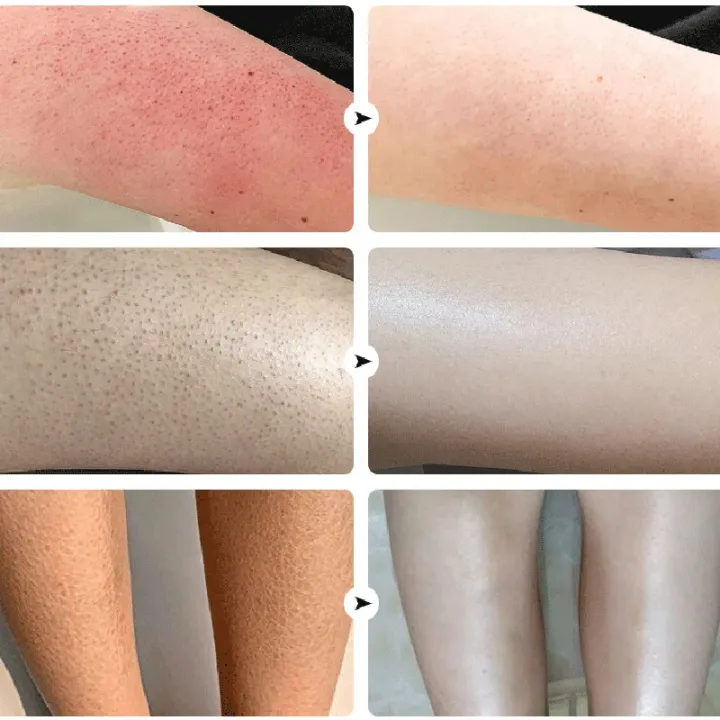 Coarse%20body%20hair,%20removal,%20cyst%20removal,%20Pila,%20good%20cream,%20keratosis,%20hairy%20chicken,%20skin%20condition,%20hole%20modification,%20dark%20spots,%20moisturizing,%20whitening,%20smooth%20skin%20care%20-%20Image%203