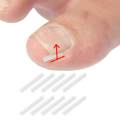 10Pieces Ingrown Toenail Corrector Strips Toenail Correction Tool Men. 