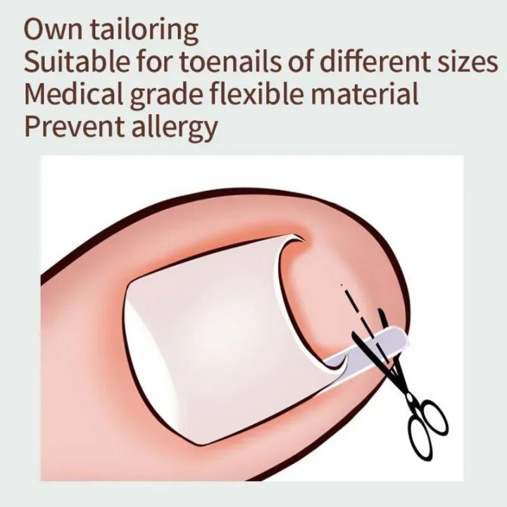10pcs%20Ingrown%20Toenail%20Correction%20Tool%20Ingrown%20Toe%20Nail%20Treatment%20Elastic%20Patch%20Sticker%20Straightening%20Clip%20Brace%20Pedicure%20Tool%20-%20Image%204