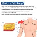 Lipomas Removal Spray Relief Pain Treat Skin Swelling 50ml Nodule Removal Cellulite Spray Lipolysis Ointment Fat Lump U6M8.