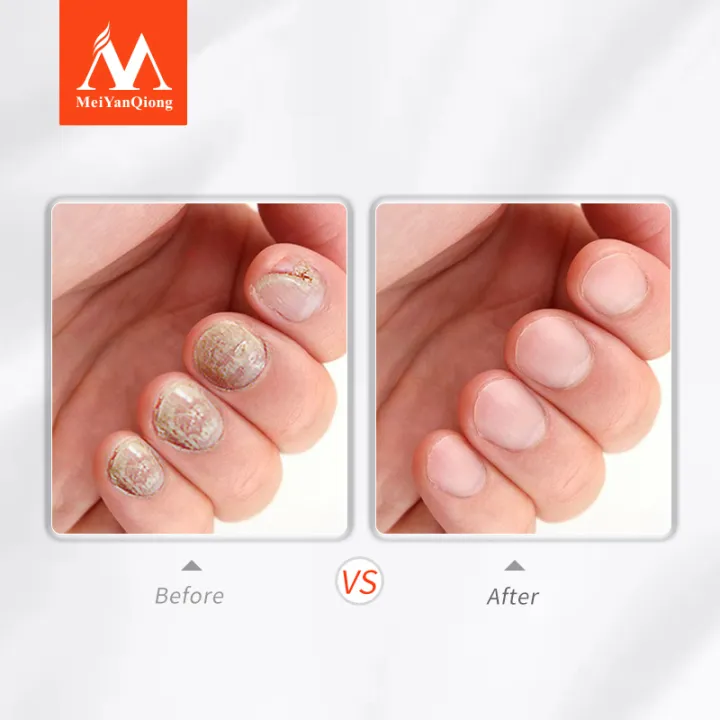 MeiYanQiong%20Lavender%20Fungal%20Nail%20Treatment%20Essential%20Oil%20Nail%20Art%20&%20Tools%20Promote%20Nails%20Grow%20Healthy%20Nail%20Treatment%20Onychomycosis%20Foot%20Care%20-%20Image%204