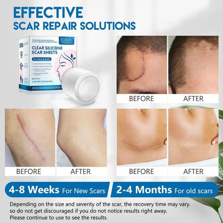 Efficient%20Silicone%20Scar%20Removal%20Gel%20Tape%20For%20Surgery%20Scar%20Repair%20Sticker%20Sheet%20Therapy%20Patch%20Waterproof%20Skin%20Care%20Patches%20-%20Image%203