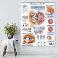 WANGART Poster Diseases of the Eye Chart Posters Refractiv Canvas print Wall Pictures for Medical Education Home Decor. 