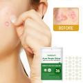 36 Patches Waterproof Acne Pimple Patch Stickers Acne Treatment Pimple Remover Tool Invisible Breathable Acne Patch Skin Care. 