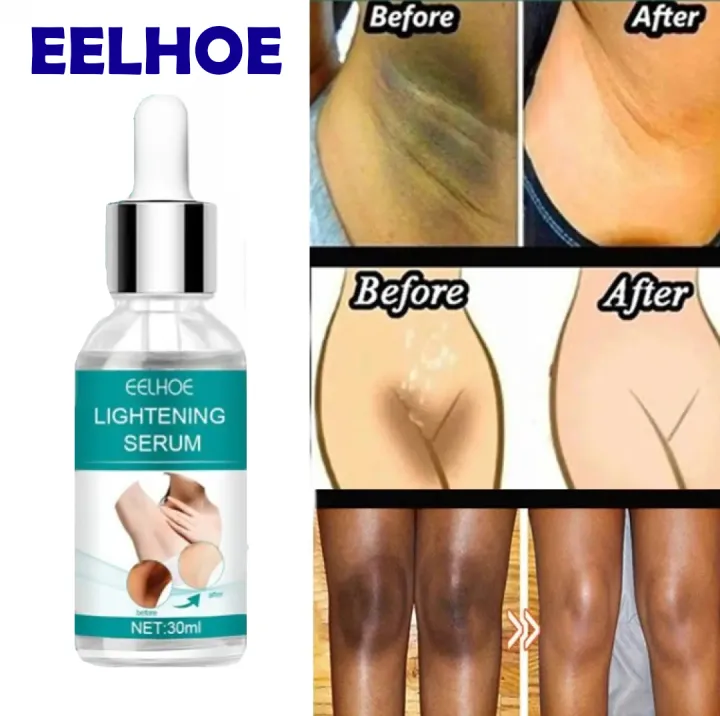 EELHOE%20Dark%20Underarm%20Brightener%20Professional%20Quality%20Korean%20Skin%20Darkness%20Remover%20-%20Image%202