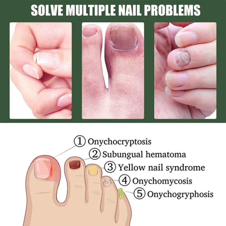 EELHOE%20Makes%20Your%20Nail%20Clean%20EELHOE%20Nail%20Repair%20Serum%20Nail%20Repair%20Oil%2015ML%20-%20Image%208