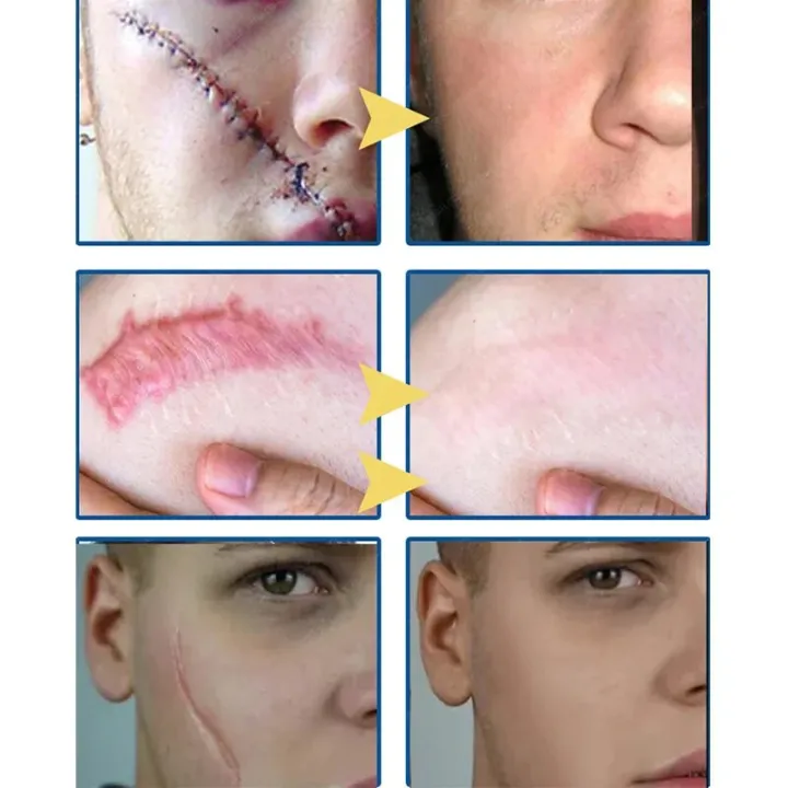 Fast%20Scar%20Removal%20Cream%20Effective%20Treatment%20Stretch%20Marks%20Burn%20Surgical%20Scars%20Acne%20Spots%20Repair%20Whitening%20Moisturizing%20Skin%20Care%20-%20Image%202