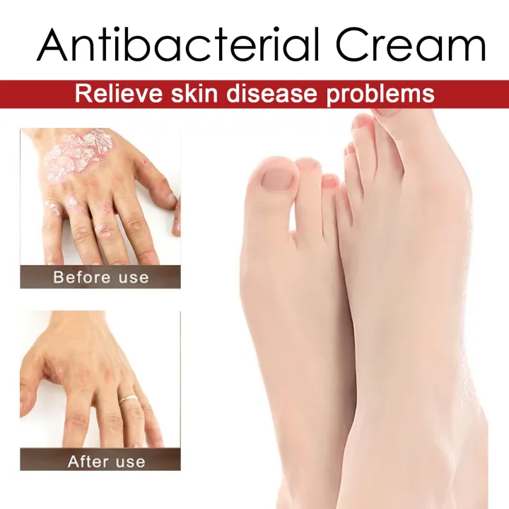 Psoriasis%20Treatment%20Cream%20Antibacterial%20Dermatitis%20Eczema%20Therapy%20Relieve%20Rash%20Urticaria%20Skin%20Herbal%20Skin%20Anti%20Itch%20Ointment%2030g%20-%20Image%205