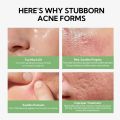 LANBENA Salicylic Acid Acne Spot Serum Cleanses Pores And Reduces Acne Oil Control Brightening Skin Acne Treatment Serum 10ml. 