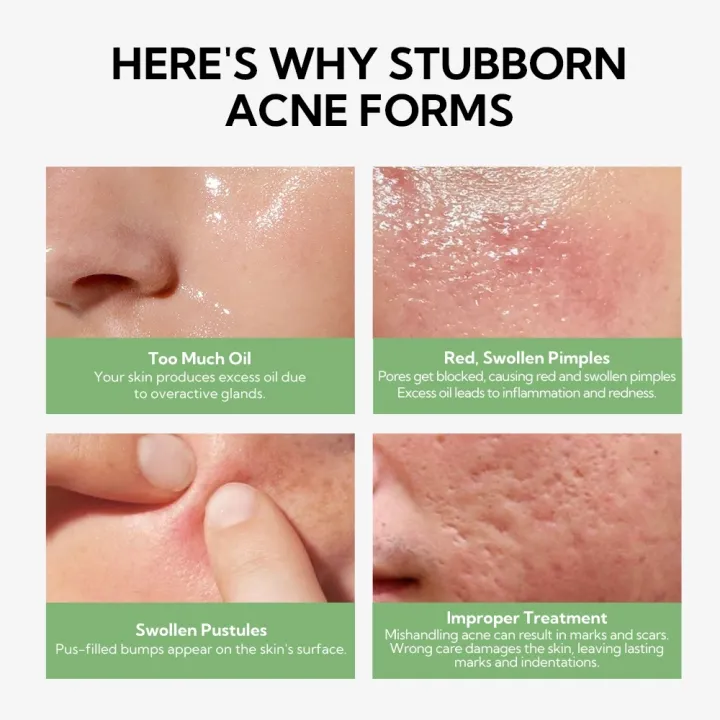 LANBENA%20Salicylic%20Acid%20Acne%20Spot%20Serum%20Cleanses%20Pores%20And%20Reduces%20Acne%20Oil%20Control%20Brightening%20Skin%20Acne%20Treatment%20Serum%2010ml%20-%20Image%203