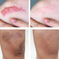 50ml Scar Removal Gel - Effective Stretch Mark, Acnes Spots, Burns and Surgical Scars Treatment Cream - Retinol, Allantoin,Vitamin E - Post Surgery Skin Repair Supplies No Side Effects. 