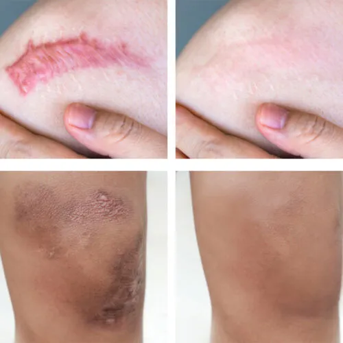 50ml%20Scar%20Removal%20Gel%20-%20Effective%20Stretch%20Mark,%20Acnes%20Spots,%20Burns%20and%20Surgical%20Scars%20Treatment%20Cream%20-%20Retinol,%20Allantoin,Vitamin%20E%20-%20Post%20Surgery%20Skin%20Repair%20Supplies%20No%20Side%20Effects%20-%20Image%207