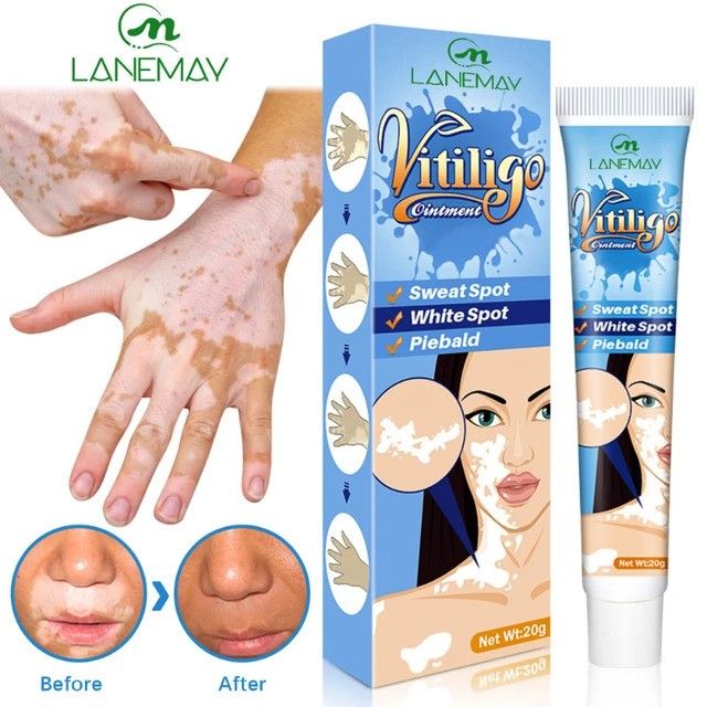20g Herbal Extract Vitiligo Ointment Remove Ringworm White Spot Removal Skin White Spot Leukoplakia Disease Treatment Cream
