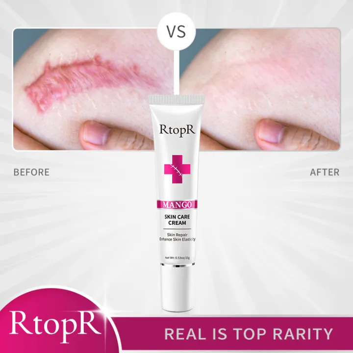 RtopR%20Scar%20Removal%20Cream%20Acne%20Scar%20Removal%20Cream%20Repair%20Skin%20Care%20Pregnancy%20Burn%20Surgery%20Scar%20Remover%20Skin%20Repair%20Blemish%20Scar%20Gel%2015g%20-%20Image%206