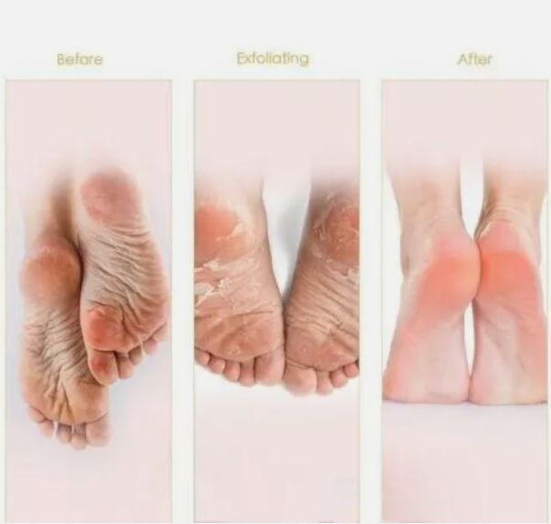 Exfoliating%20Peel%20Off%20Foot%20Mask%20Remove%20Hard%20Dead%20Skin%20Callus%20Sock%20Baby%20Soft%20Feet%20-%20Image%204