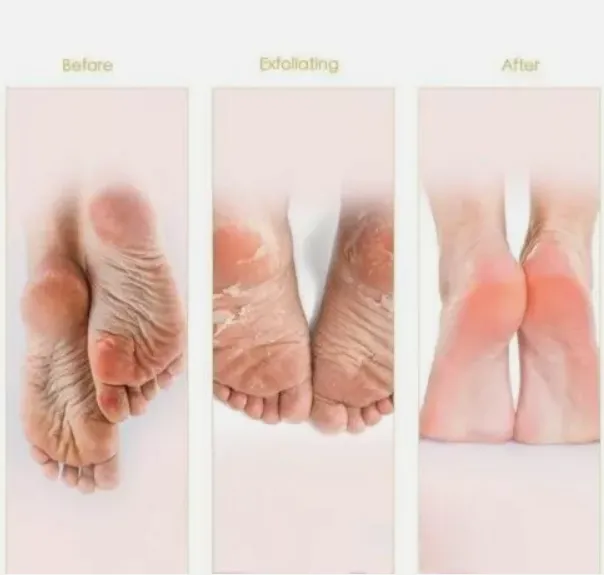 Exfoliating%20Peel%20Off%20Foot%20Mask%20Remove%20Hard%20Dead%20Skin%20Callus%20Sock%20Baby%20Soft%20Feet%20-%20Image%204