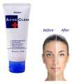 Mistine Acne Clear Facial Foam Face Wash - 85Gm (Made In Thailand) - Face Wash. 