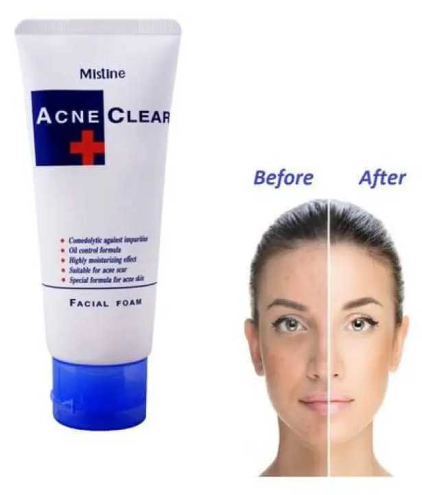 Mistine Acne Clear Facial Foam Face Wash - 85Gm (Made In Thailand) - Face Wash