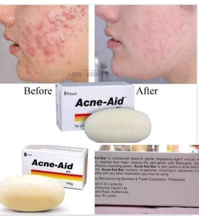 Stiefel%20Original%20Acne-Aid%20Bar%20100g%20Pimple%20Prone%20&%20Oily%20Skin%20Acne%20Aid%20Soap%20-%20Image%208