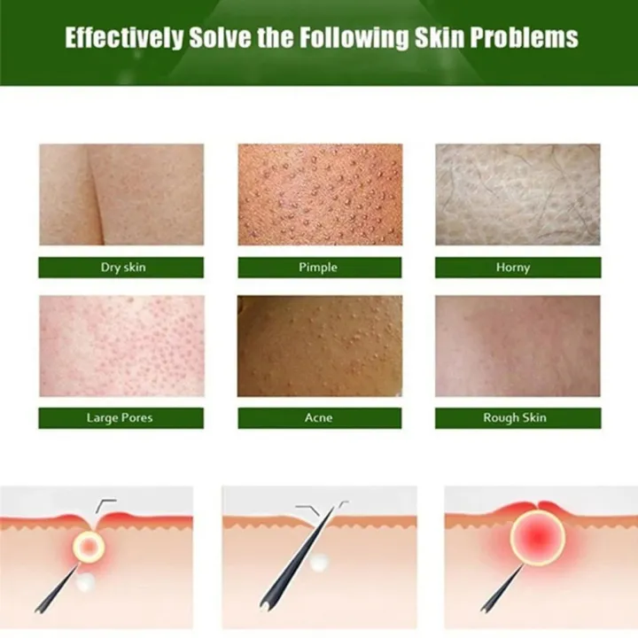Coarse%20body%20hair,%20removal,%20cyst%20removal,%20Pila,%20good%20cream,%20keratosis,%20hairy%20chicken,%20skin%20condition,%20hole%20modification,%20dark%20spots,%20moisturizing,%20whitening,%20smooth%20skin%20care%20-%20Image%205