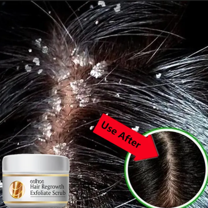 Fast%20Anti%20Dandruff%20Hair%20Relieve%20Itching%20Oil%20Control%20Treatment%20Repair%20Scalp%20Cleaning%20Exfoliating%20Products%20Antipruritic%20Hair%20Care%20OutlierO%20-%20Image%203