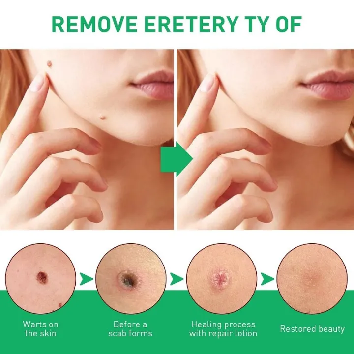 Effective%20Foot%20Corn%20Remover%20Care%20Remove%20Foot%20Calluses%20Remove%20Warts%20Smooth%20Skin%20Mild%20Wart%20Remover%20Corns%20Foot%20Care%20Liquid%20Solution%20-%20Image%205