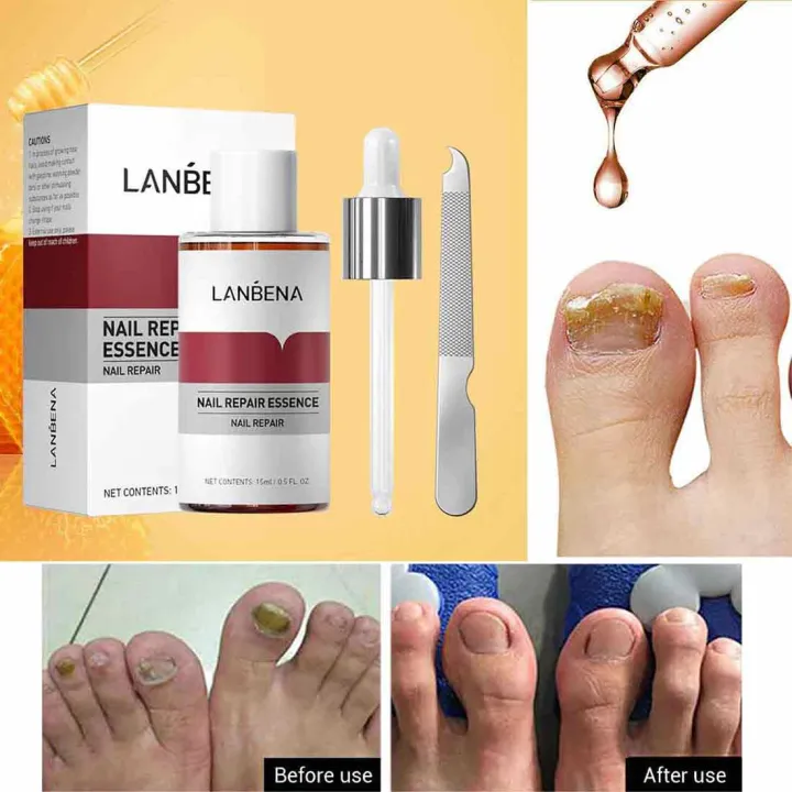 LANBENA%20Nail%20Repair%20Essence%20Serum%2015ml%20%E2%80%93%20Effective%20Nail%20Fungus%20&%20Damage%20-%20Image%203