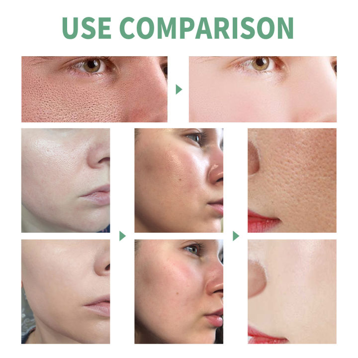 Salicylic%20Acid%20Pores%20Shrink%20Refining%20Cream%20Repair%20Large%20Open%20Pore%20Removal%20Black%20Dots%20Blackhead%20Acne%20Marks%20Facial%20Skin%20Care%20Serum%20-%20Image%203
