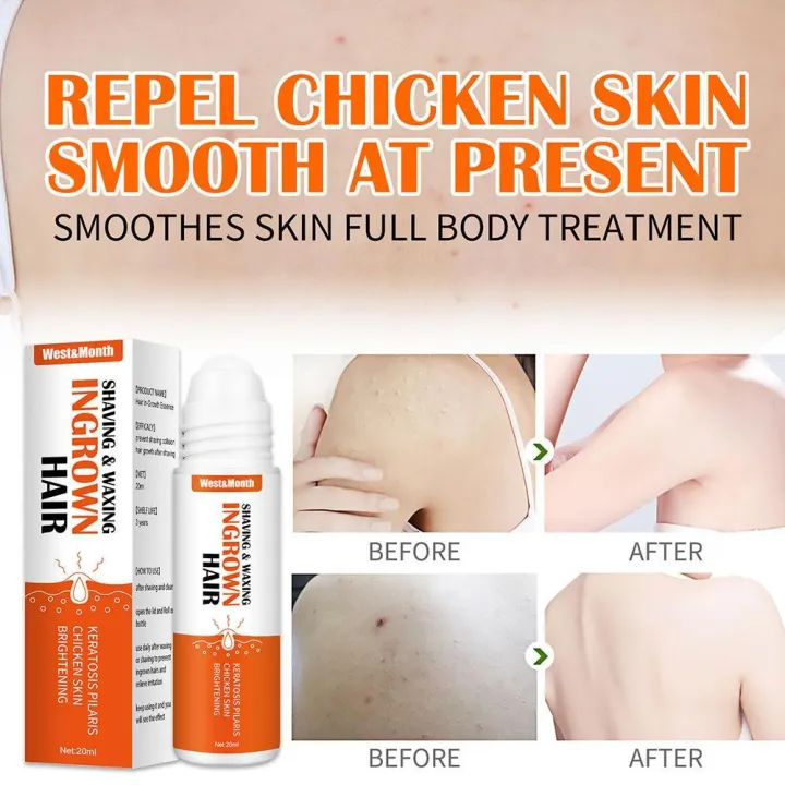 Ingrown%20hair%20after%20shaving%20treatment%20for%20dark%20spots%20repair%20serum%20M2Z1%20-%20Image%204