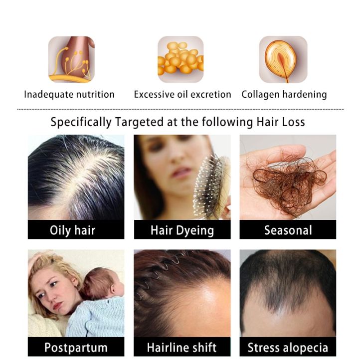 Unisex%20Anti%20Hair%20Loss%20Ginger%20Shampoo%20Hair%20Growth%20Products%20Shampoo%20Against%20Hair%20Loss%20Mild%20Treatment%20Ginger%20Shampoo%20For%20Hair%20Loss%20-%20Image%203