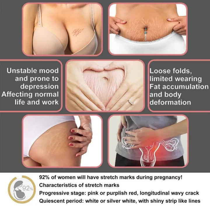 Stretch%20Mark%20Remover%20Cream%20With%20Coconut%20Sunflower%20Oil%2050ml%20Natural%20Beeswax%20Maternity%20Skin%20Care%20Freckl%20Spot%20Repair%20Massage%20Lotion%20-%20Image%205