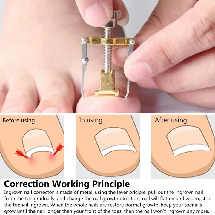 Nail%20Care%20machine%20for%20nail%20repair%20Pedicure%20Correction%20Tool%20Foot%20Correcting%20Device%20Ingrown%20Toenail%20Fixer%20Toe%20nail%20Recover-The%20Asia%20Express%20-%20Image%205