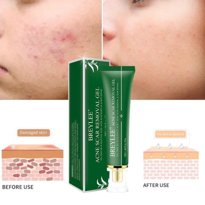 Breylee%20Acne%20&%20Scar%20Removal%20Gel%20-%2030g%20-%20Image%202