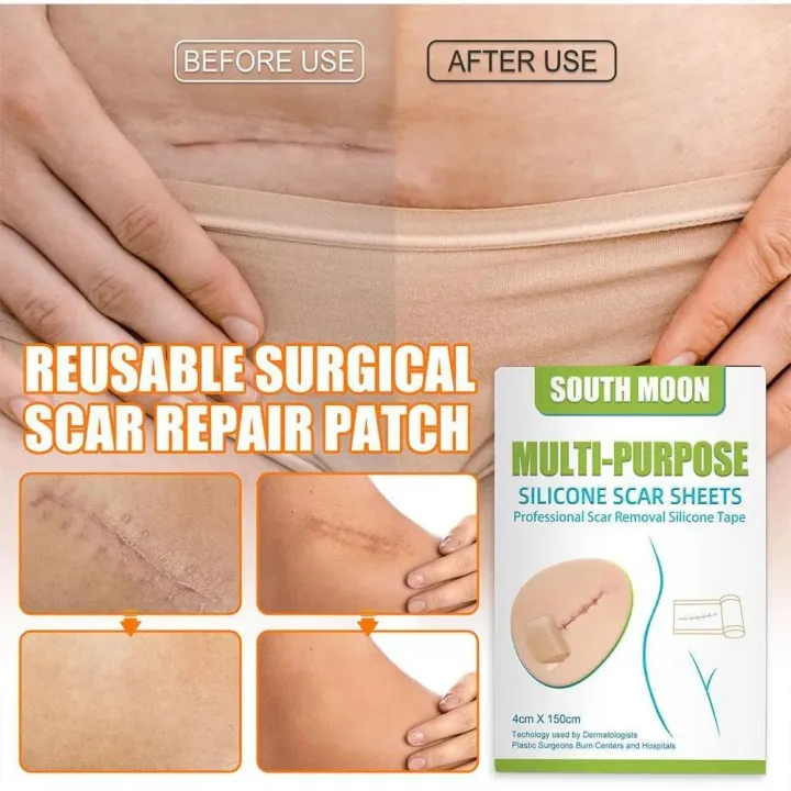 1Roll%20Scar%20Treatment%20Silicone%20Gel%20Sheet%20Efficient%20Surgery%20Scar%20Removal%20Therapy%20Patch%20For%20Acne%20Trauma%20Burn%20Scar%20Skin%20Repair%20-%20Image%204