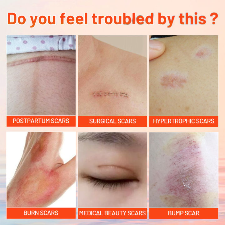 MeiYanQiong%20Acne%20Scar%20Remove%20Scar%20Cream%20Skin%20Repair%20Stretch%20Marks%20Keloid%20Remover%20Desalination%20Scar%20Face%20Cream%20Spots%20Effective%20Treatment%2015g%20-%20Image%204