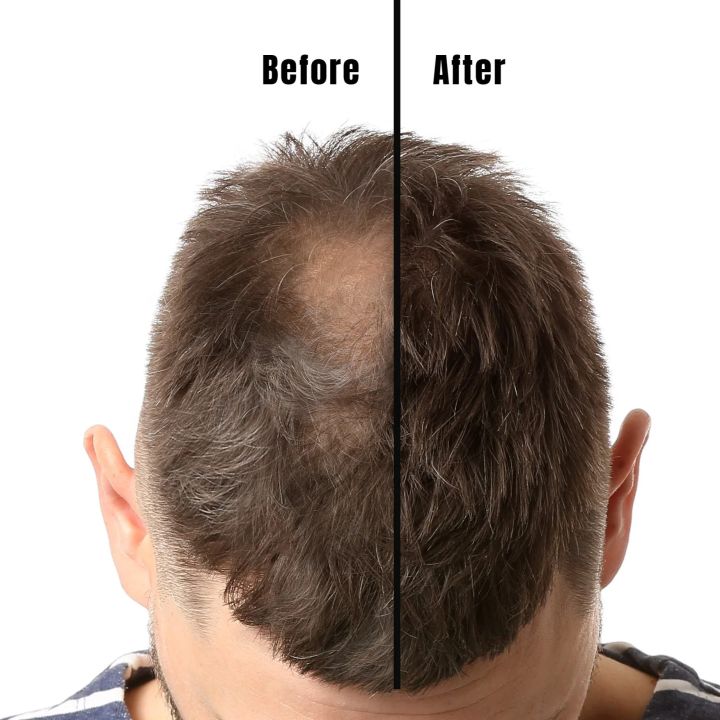 Kirkland%20Signature%20Topical%20Minoxidil%205%25%20Extra%20Strength%20for%20Men%20Hair%20Regrowth%20Treatment%20%20-%20MNXMS%20-%20Image%206