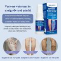 Varicose Vein Treatment Spray Vasculitis Phlebitis Spider Relief Fatigue Leg Dilation Pain Herbal Beauty Body Skin Care 30ml. 